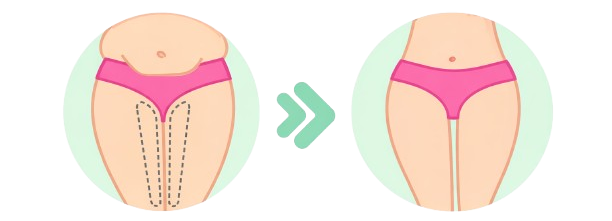 Illustration of before and after thigh fat reduction, showing slimmer and toned legs, liposuction surgery in nashik