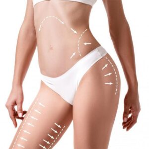 Laser Assisted Liposuction