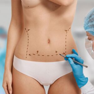 Ultrasound Assisted Liposuction