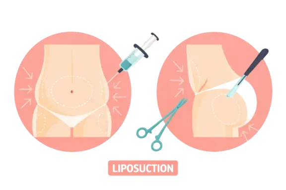 liposuction surgery in nashik